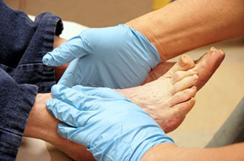 diabetic foot