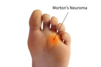 Treatment of Morton’s Neuroma