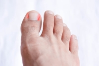 Managing Ingrown Toenails